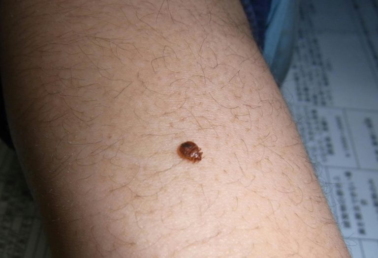 トコジラミの咬傷を防ぐ方法